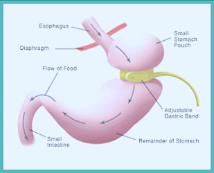 The Virtual Gastric Band Procedure